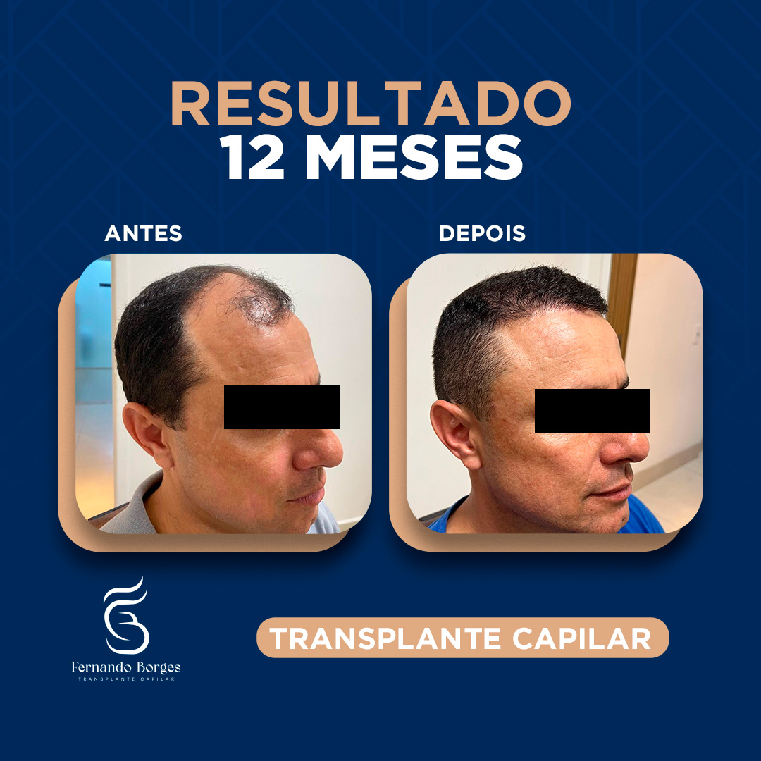 uploads/Resultado do paciente com 12 meses.Estamos aqui para te ajudar e proporcionar exatamente isso. I.jpg